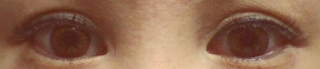 Q手術2週間後メイクなし