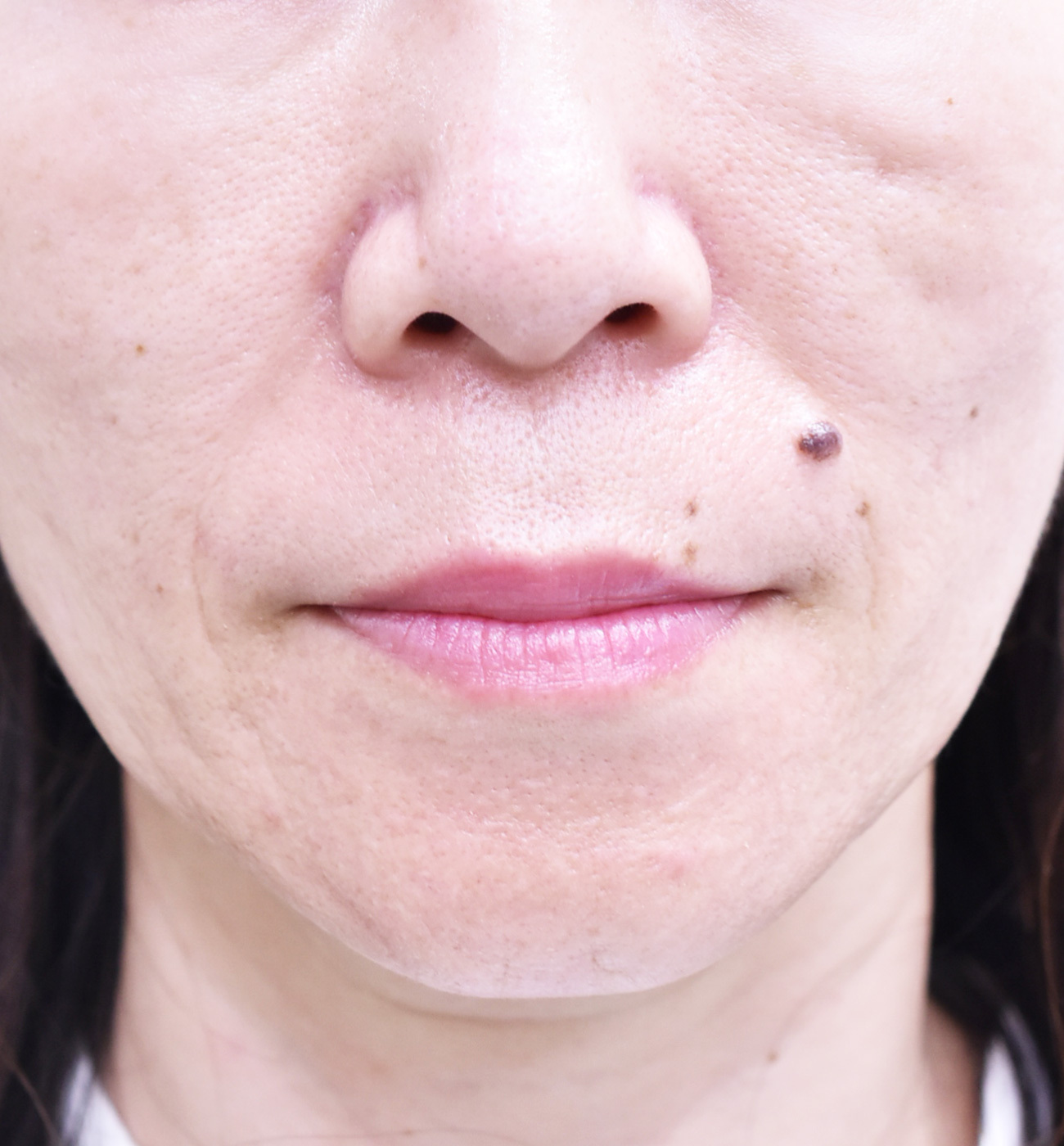 大阪　50代　女性　糸リフト（バイニードル）　手術後