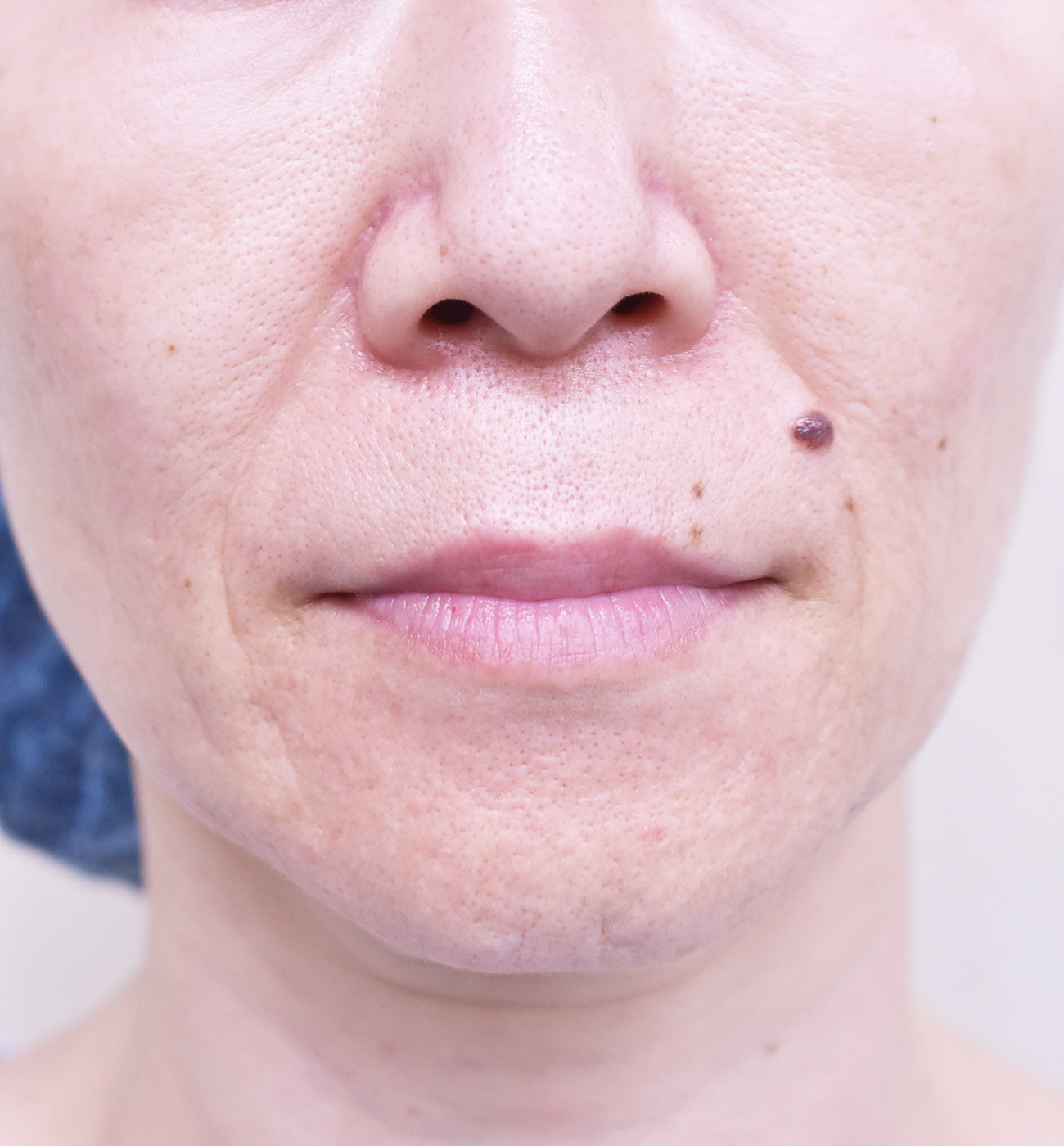 大阪 50代 女性 糸リフト(バイニードル) 手術前