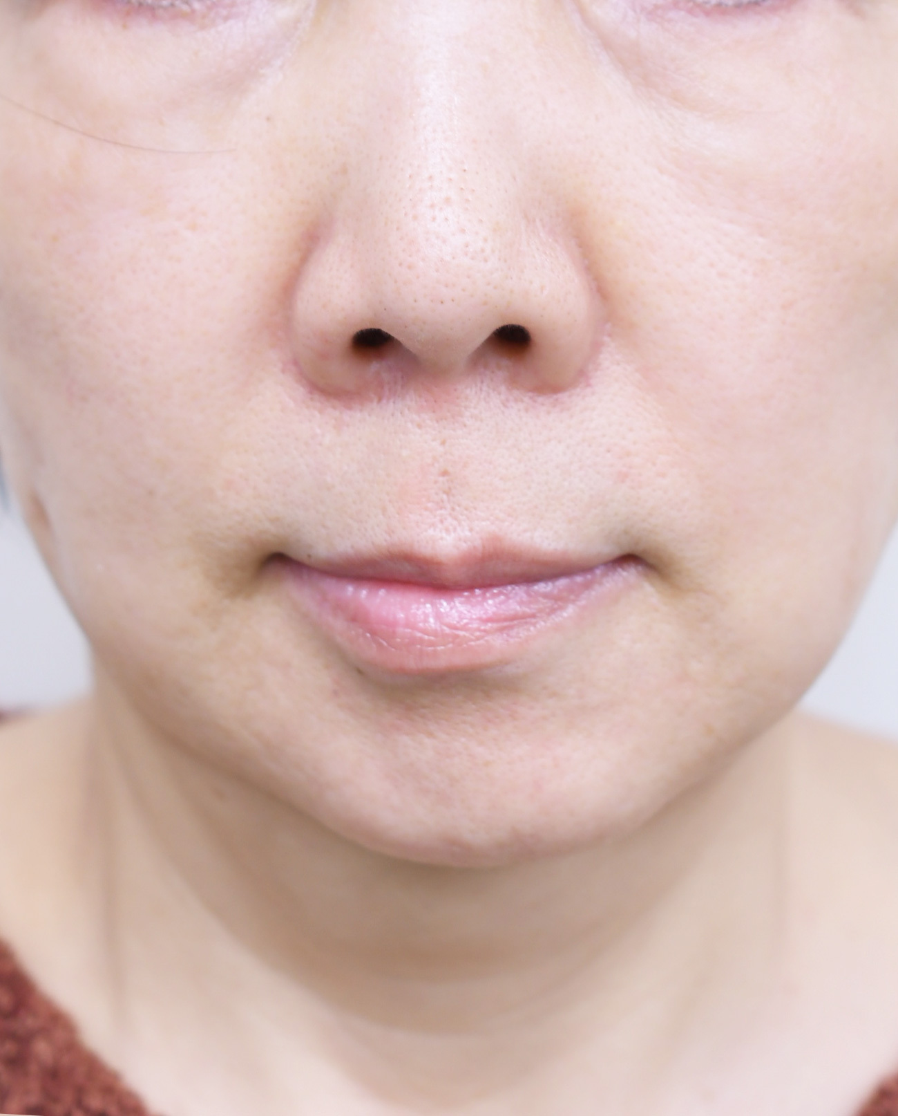 大阪　70代　女性　糸リフト（バイニードル）　手術後