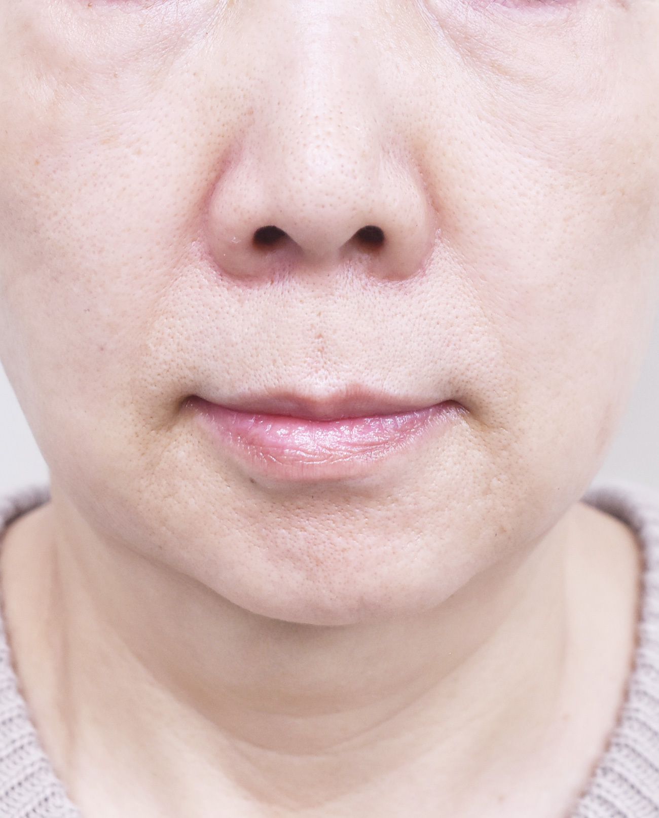 大阪　70代　女性　糸リフト（バイニードル）　手術前