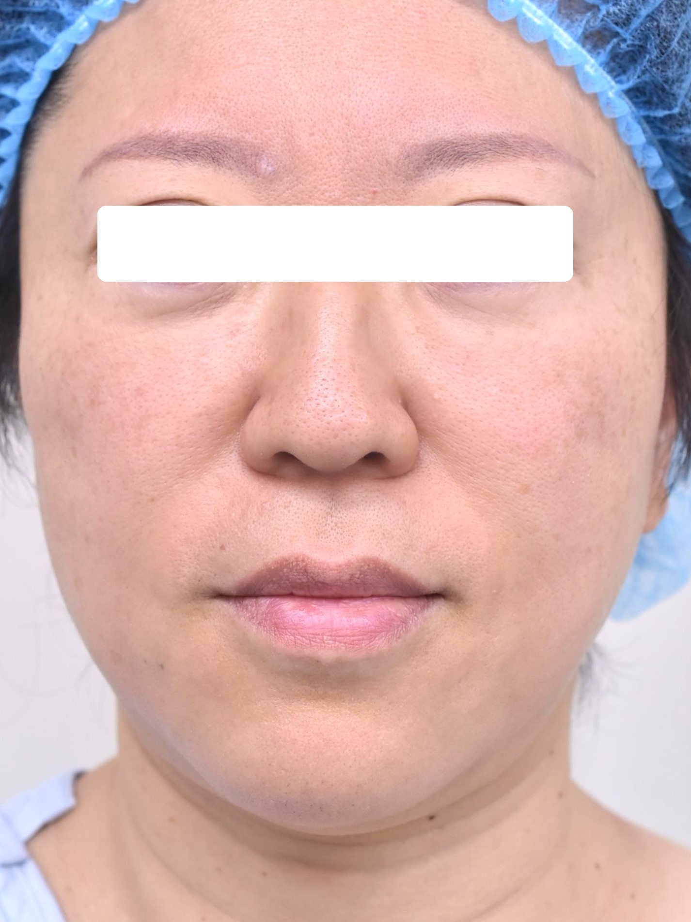 大阪 50代 女性 フェイスリフト【頬 頚】 脂肪吸引【頬 顎下】 手術前