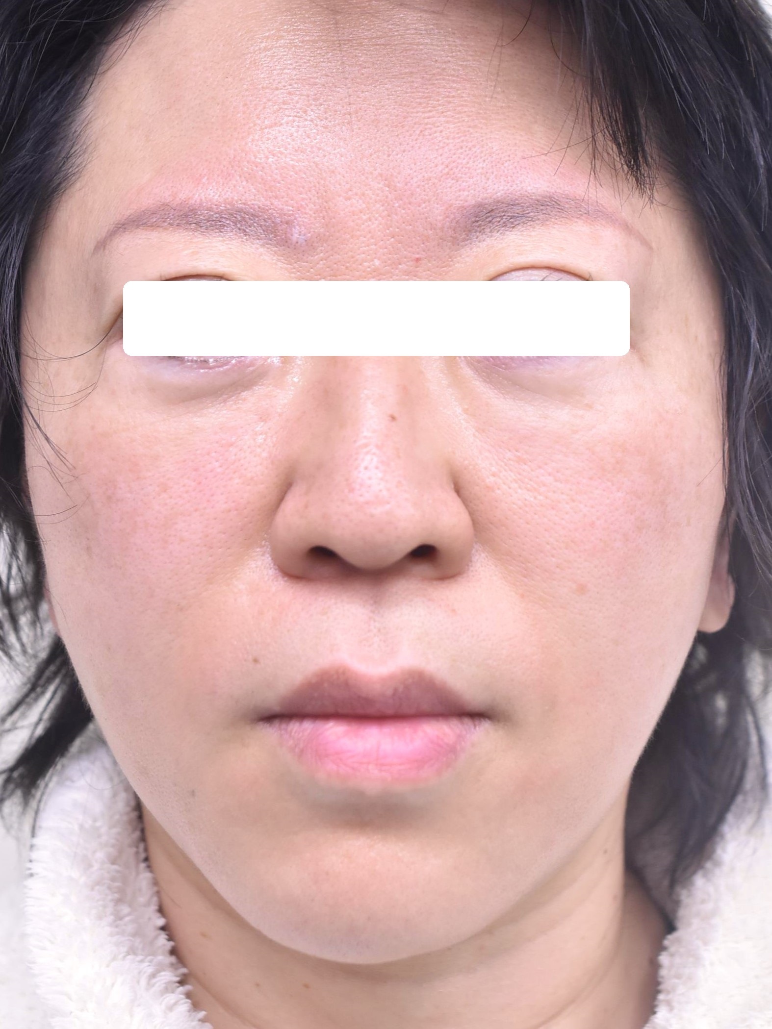 大阪　50代　女性　フェイスリフト【頬 頚】　脂肪吸引【頬 顎下】　手術後