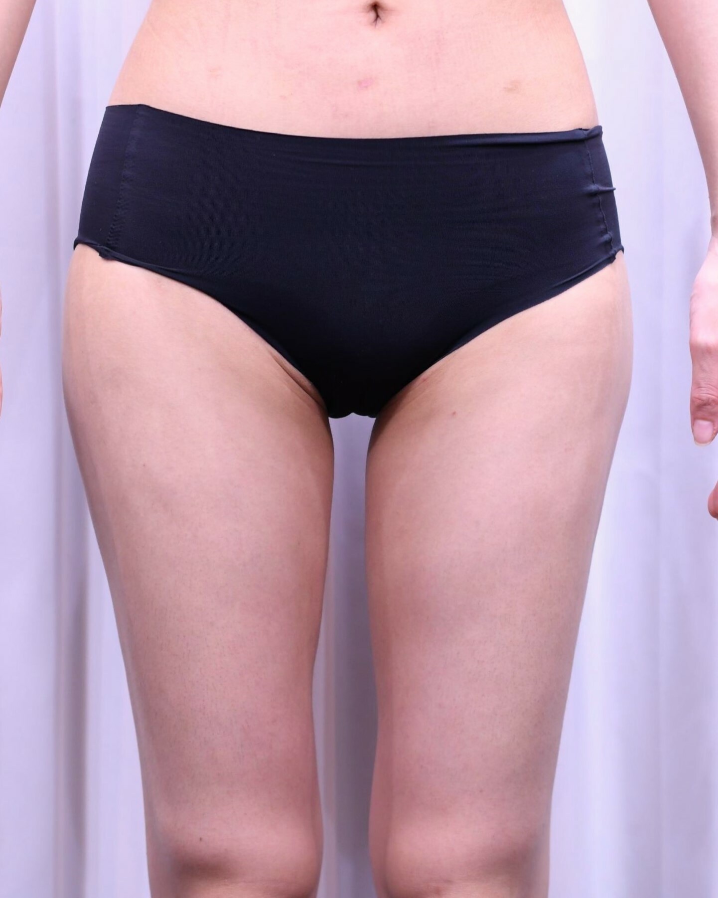 大阪　20代　女性　大腿全周脂肪吸引　脂肪注入豊胸術　手術後