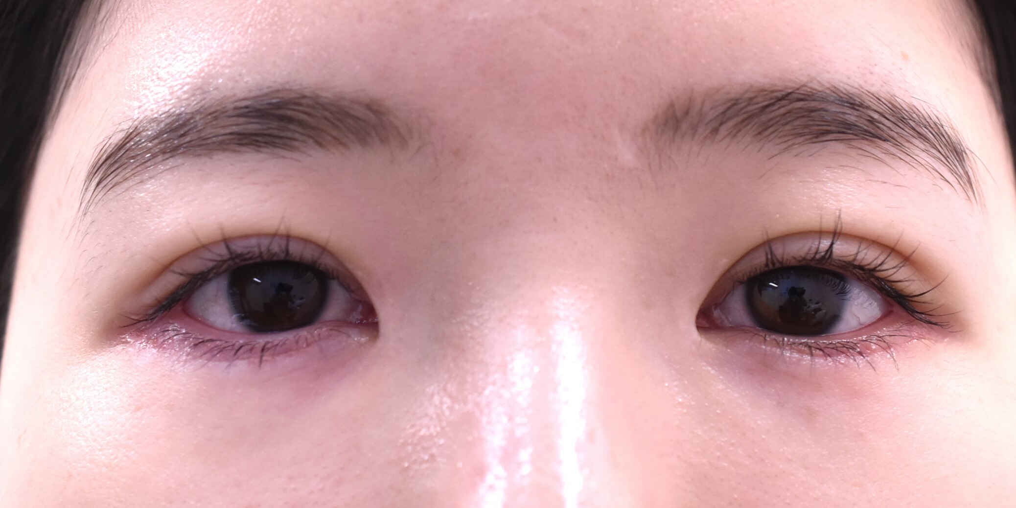 大阪　20代　女性　埋没法 下眼瞼下制術（グラマラスライン）手術後