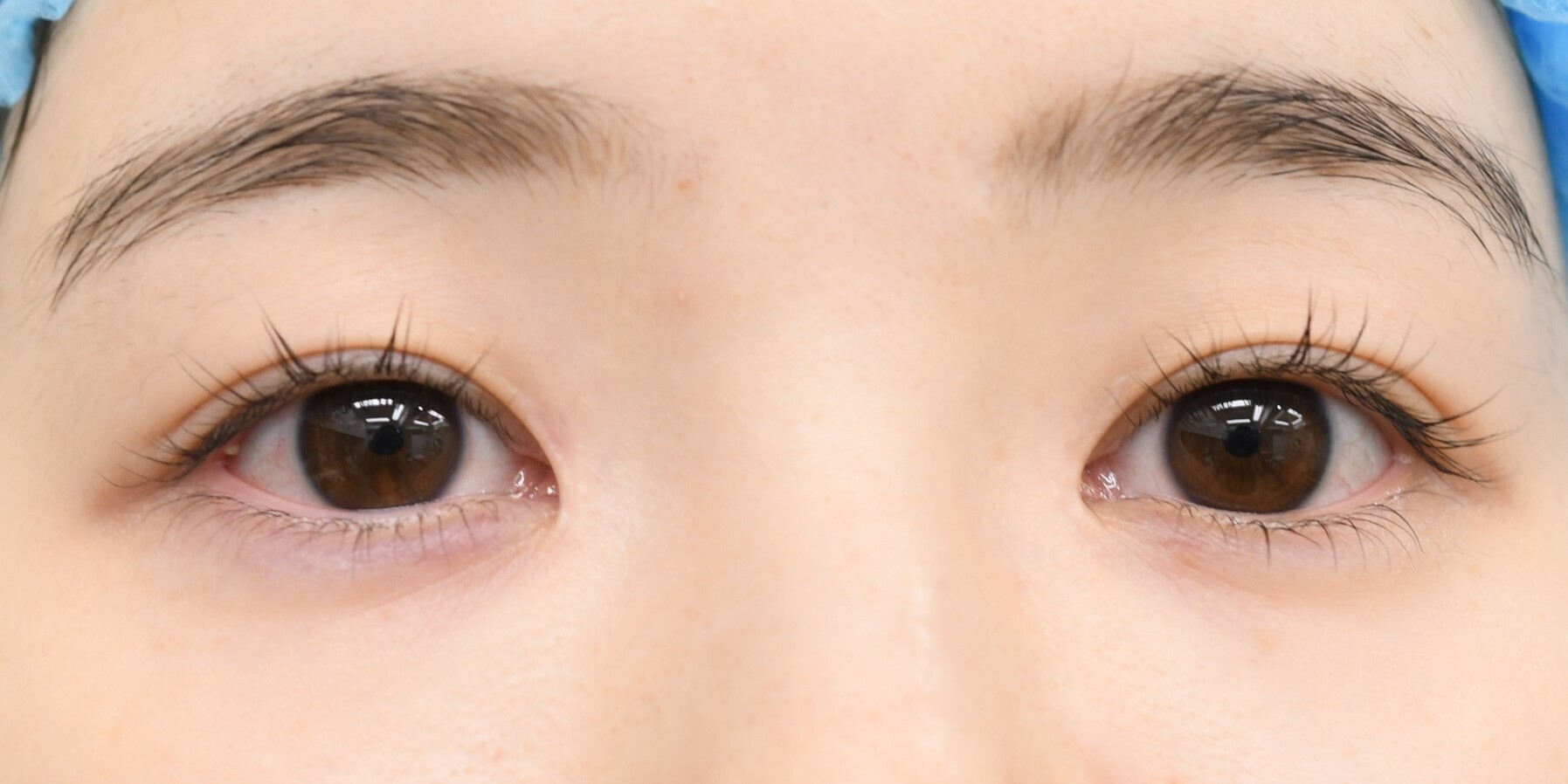 大阪　20代　女性　埋没法 下眼瞼下制術（グラマラスライン）手術前