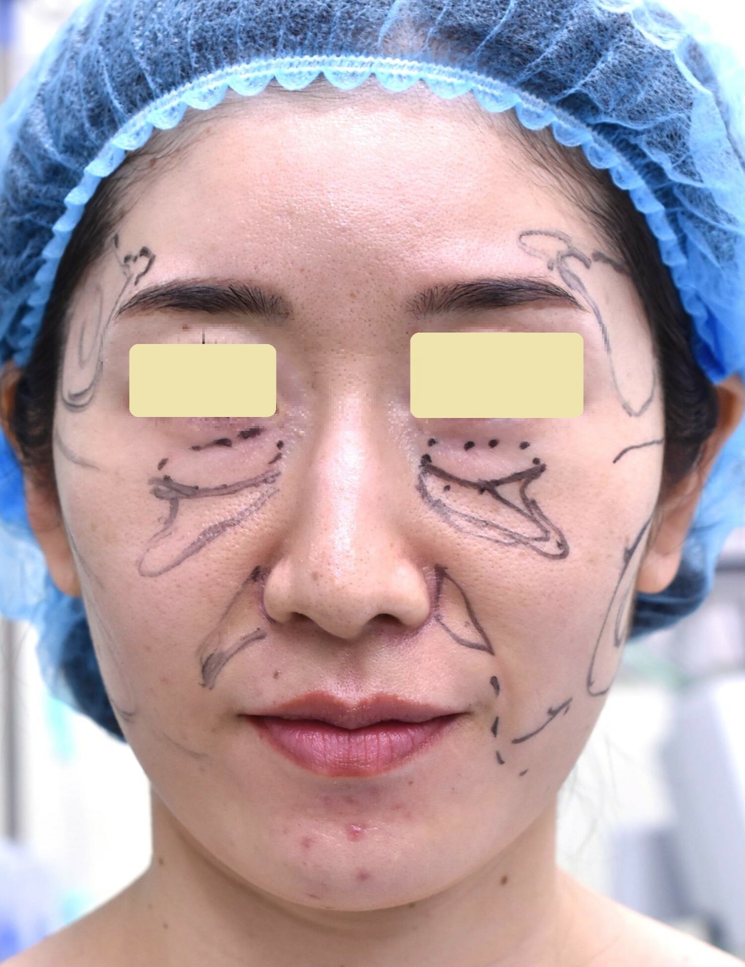 30代　女性　顔脂肪注入法　池内医師