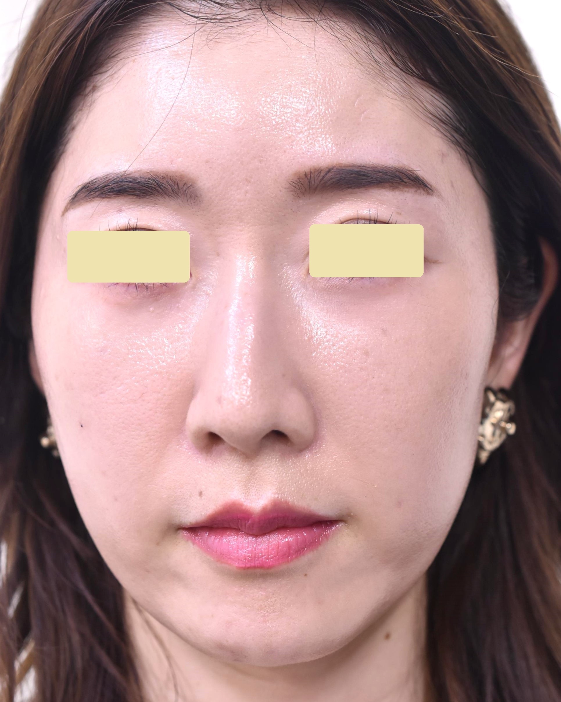 30代　女性　顔脂肪注入法　池内医師