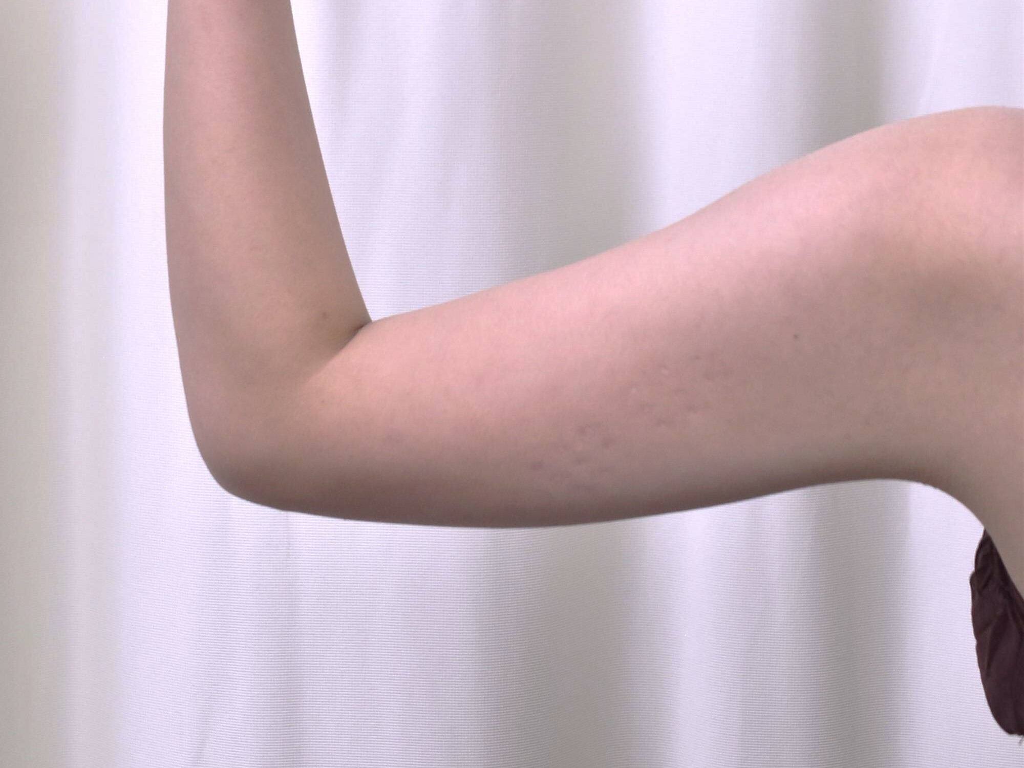 大阪 20代 女性 脂肪吸引術 二の腕 手術前