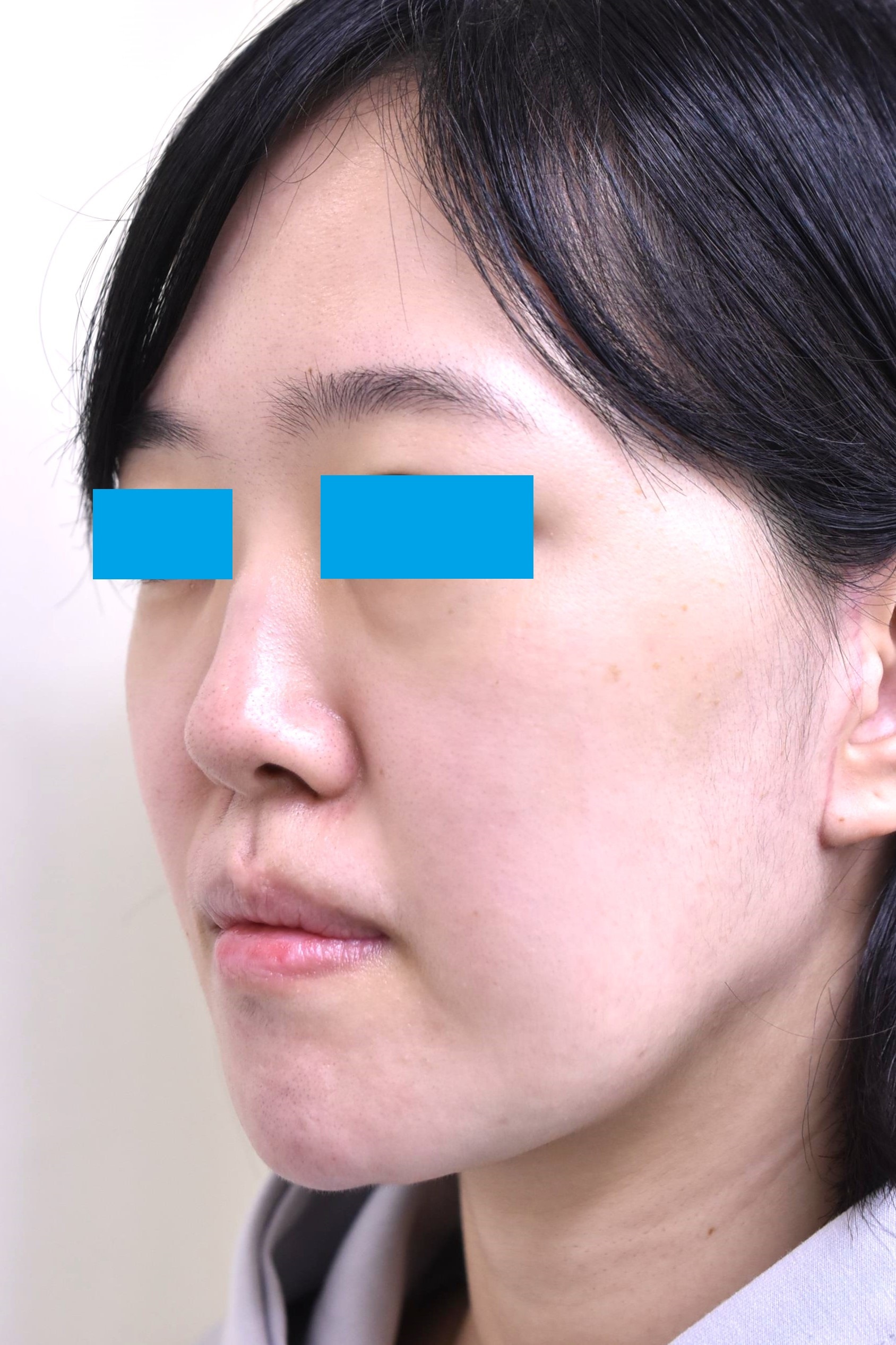 大阪　30代　女性　フェイスリフト＋頬　顎下の脂肪吸引　手術後