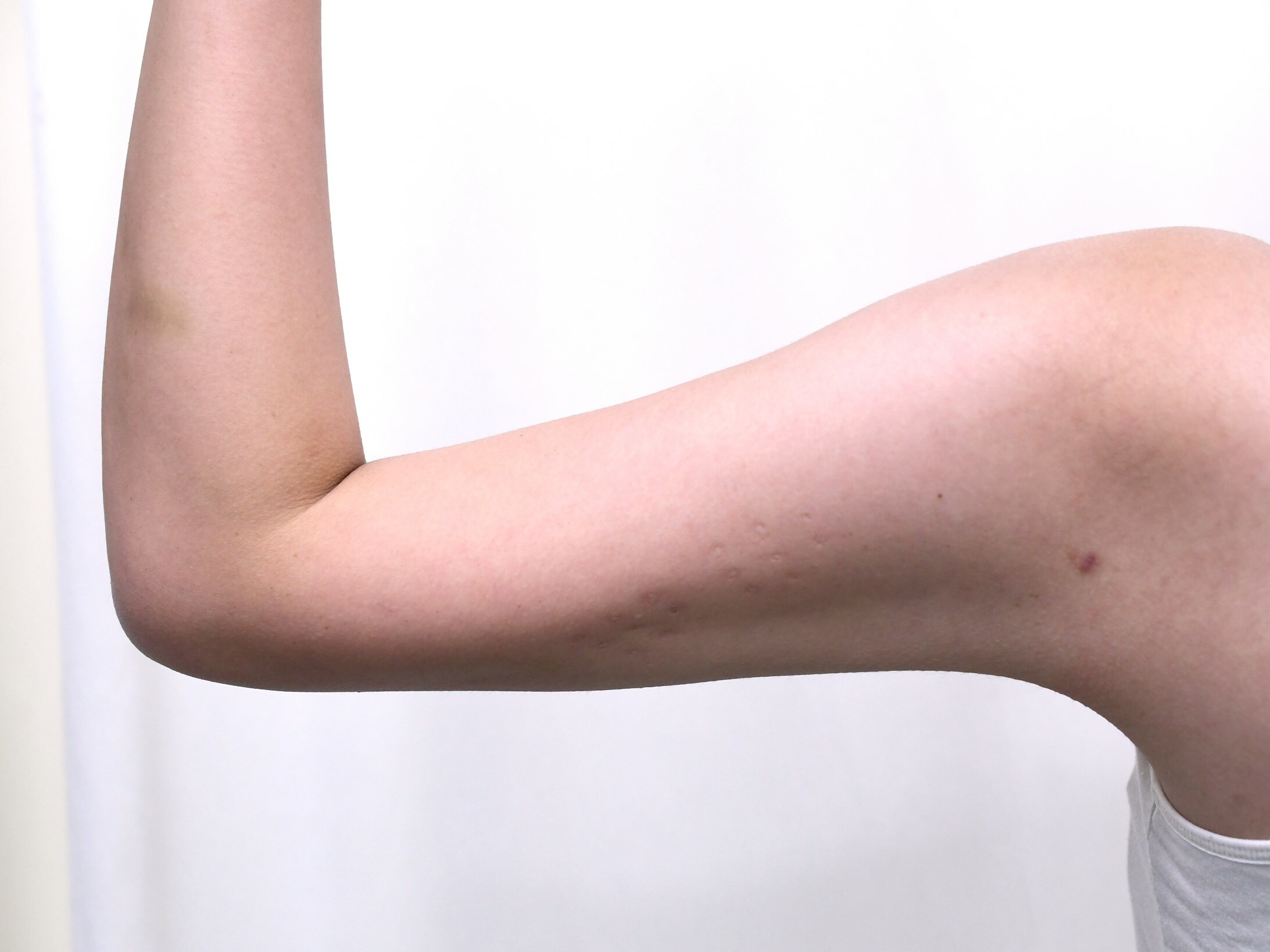 大阪　20代　女性　脂肪吸引術　二の腕　手術後