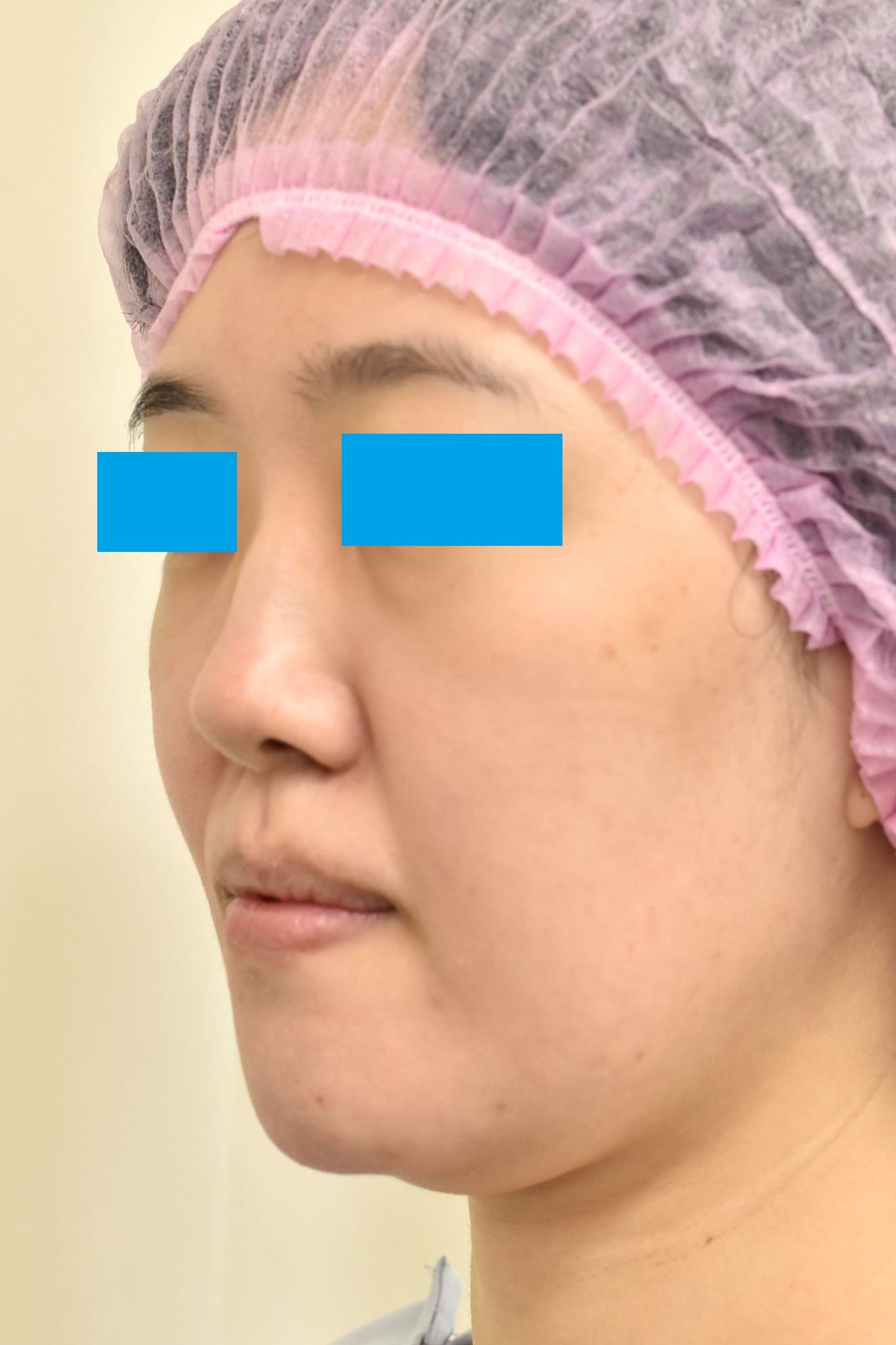 大阪 30代 女性 フェイスリフト+頬 顎下の脂肪吸引 手術前