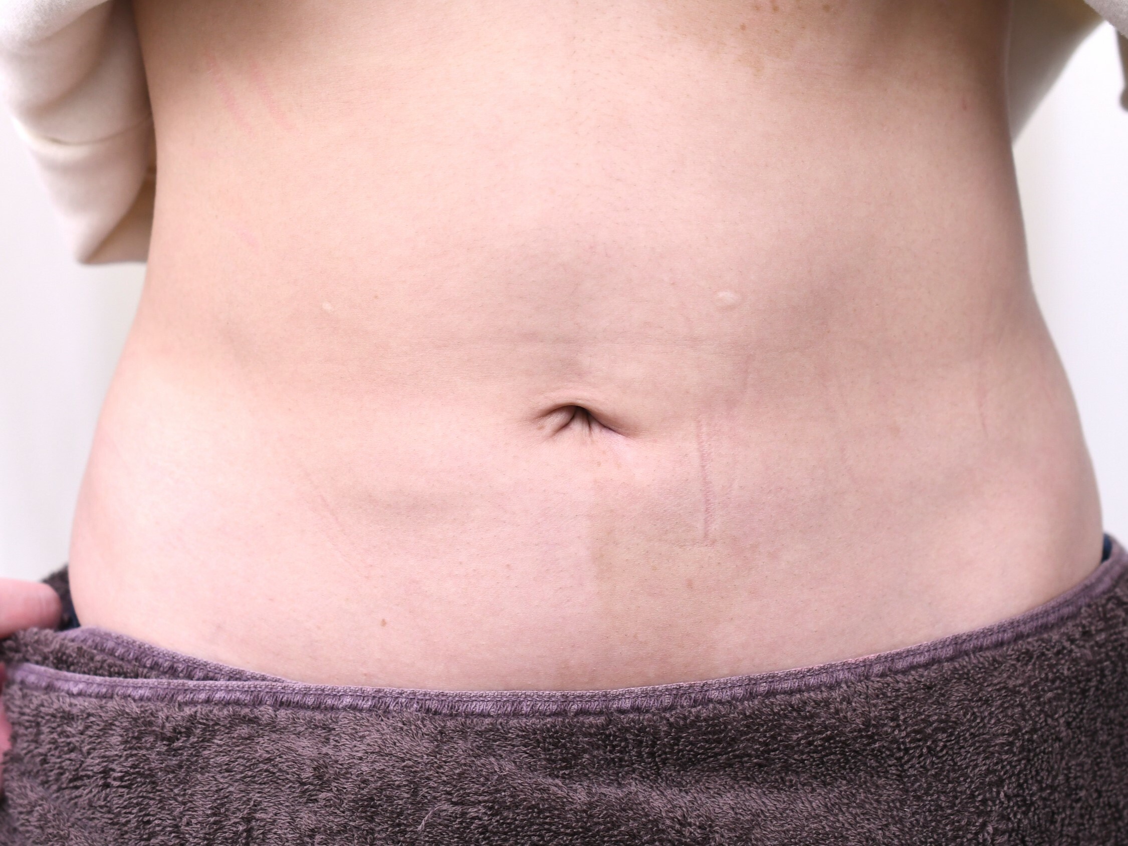 大阪　20代　女性　下腹部＋ウエスト部脂肪吸引　手術後