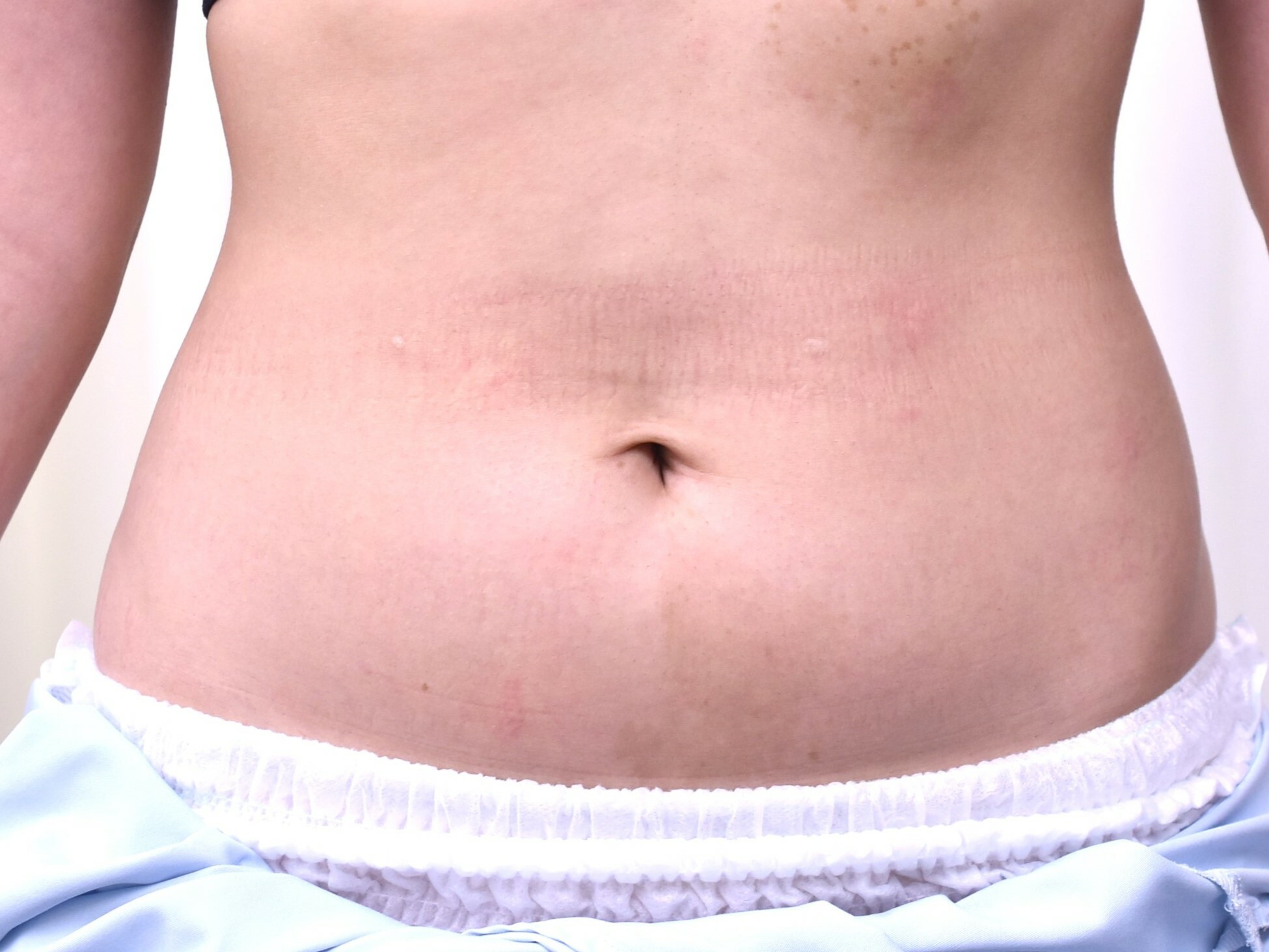 大阪 20代 女性 下腹部+ウエスト部脂肪吸引 手術前