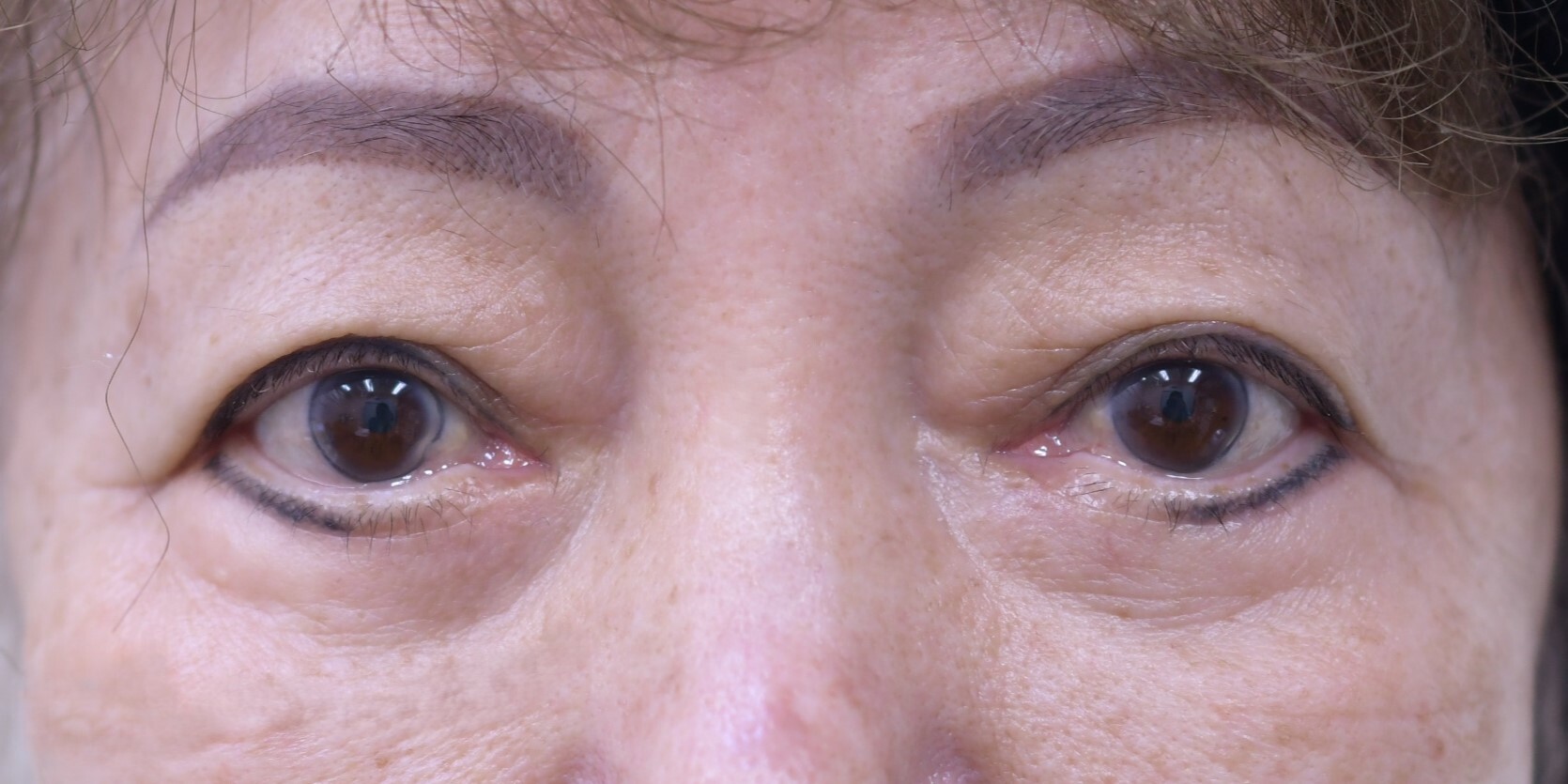 70代 女性 下眼瞼切開+脱脂 池内医師